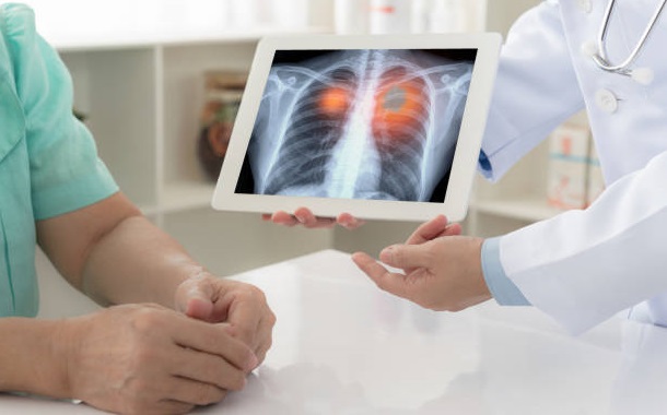 decortication surgeon best lung cancer surgeon in vashi